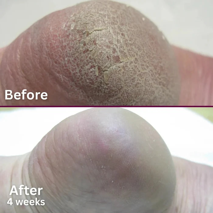 Footlogix Bye-Bye Callus Footlogix