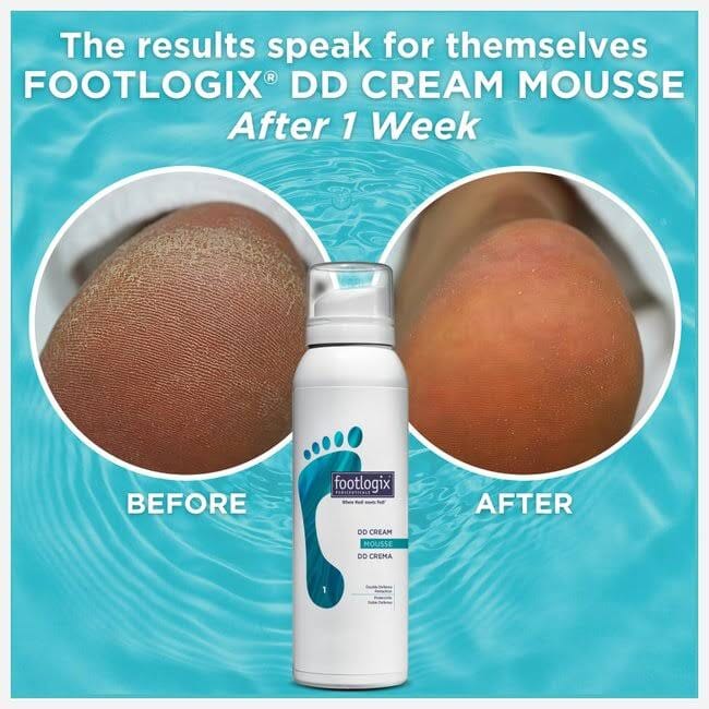 Footlogix DD Cream Mousse, 125 ml Dry to Cracked Skin Foam Footlogix