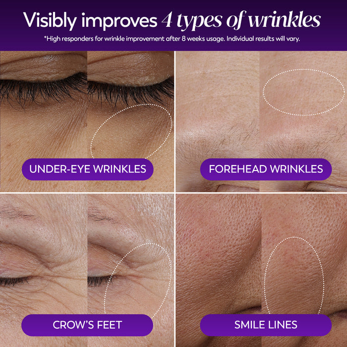 A four-panel before-and-after collage showing close-up skin results for under-eye wrinkles, forehead wrinkles, crow's feet, and smile lines. Purple labels identify each type, with dotted oval highlights over the wrinkled areas.